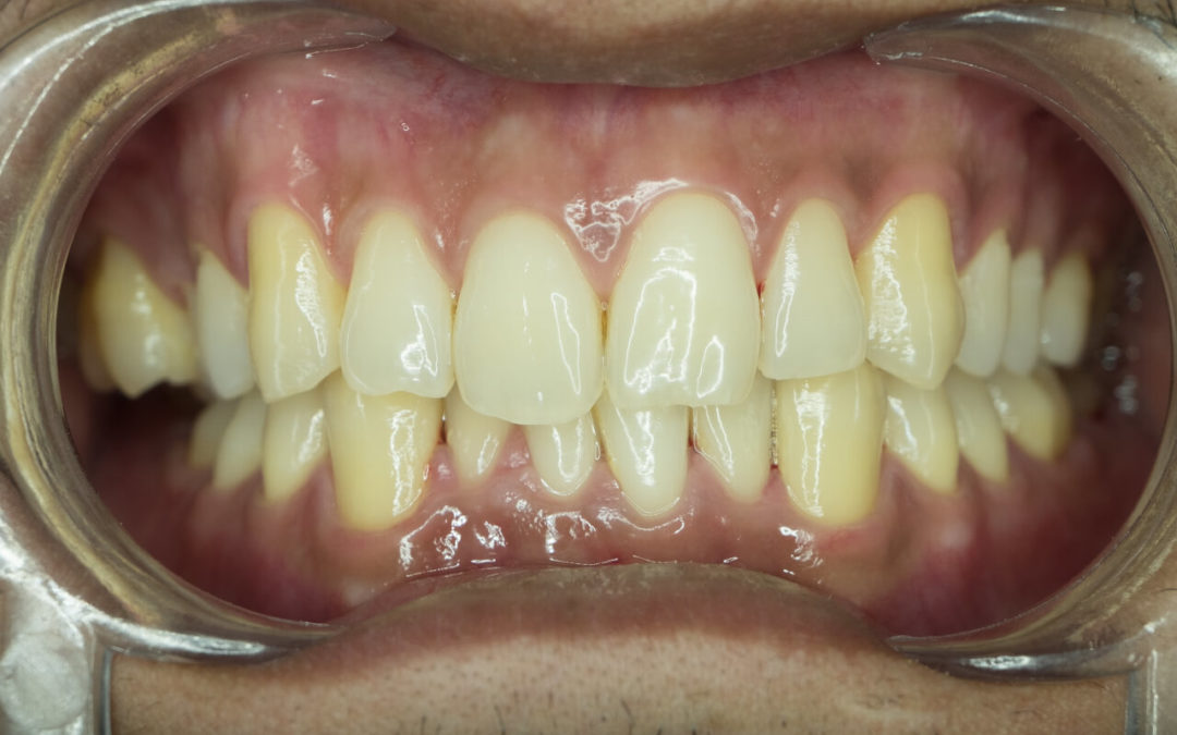 Causes And Effects Of Crossbite In Adults