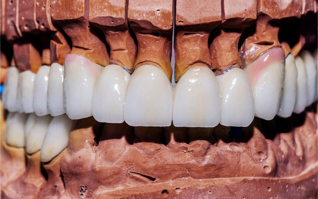 Zirconium Tooth Implants