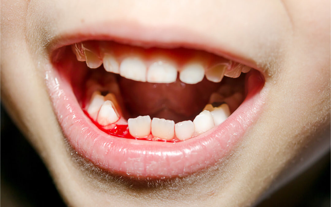 Tips for Dealing with A Dental Accident