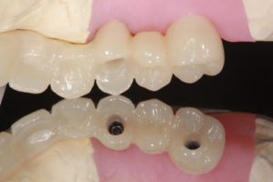 cost of all on 4 dental implants