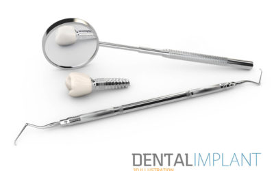 Tooth Implant Loose