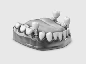 tooth implant loose