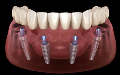 The Cost of All-On-Four Dental Implants