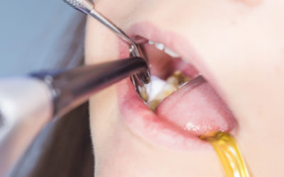 The great difference in dental bonding before and after