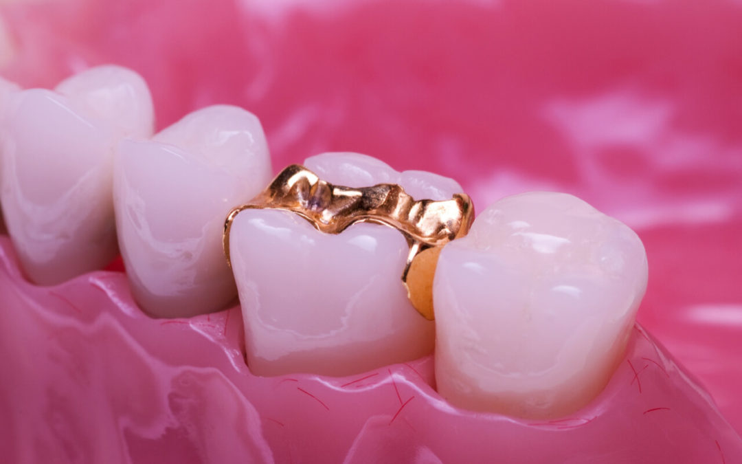 A Detailed Description of Teeth Inlay