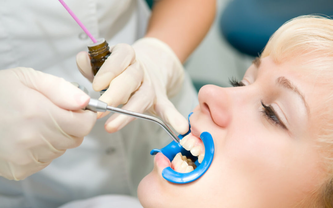 Dental sealants for adults