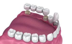 implant supported bridge