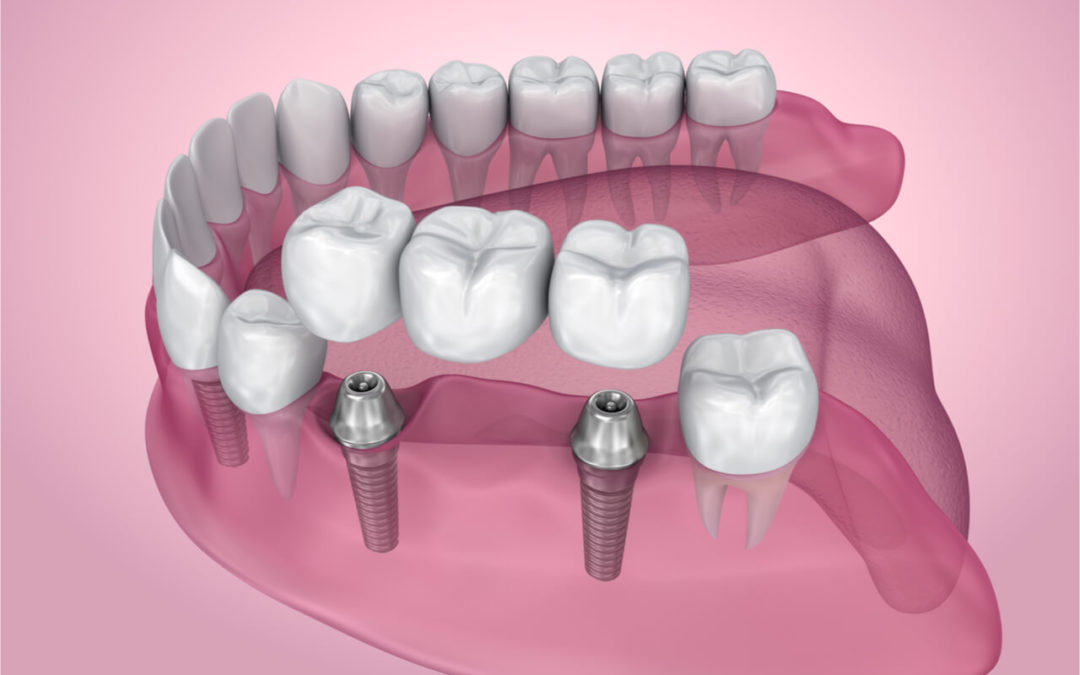 How to implement an implant supported bridge