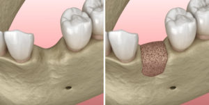 pinhole gum surgery complications
