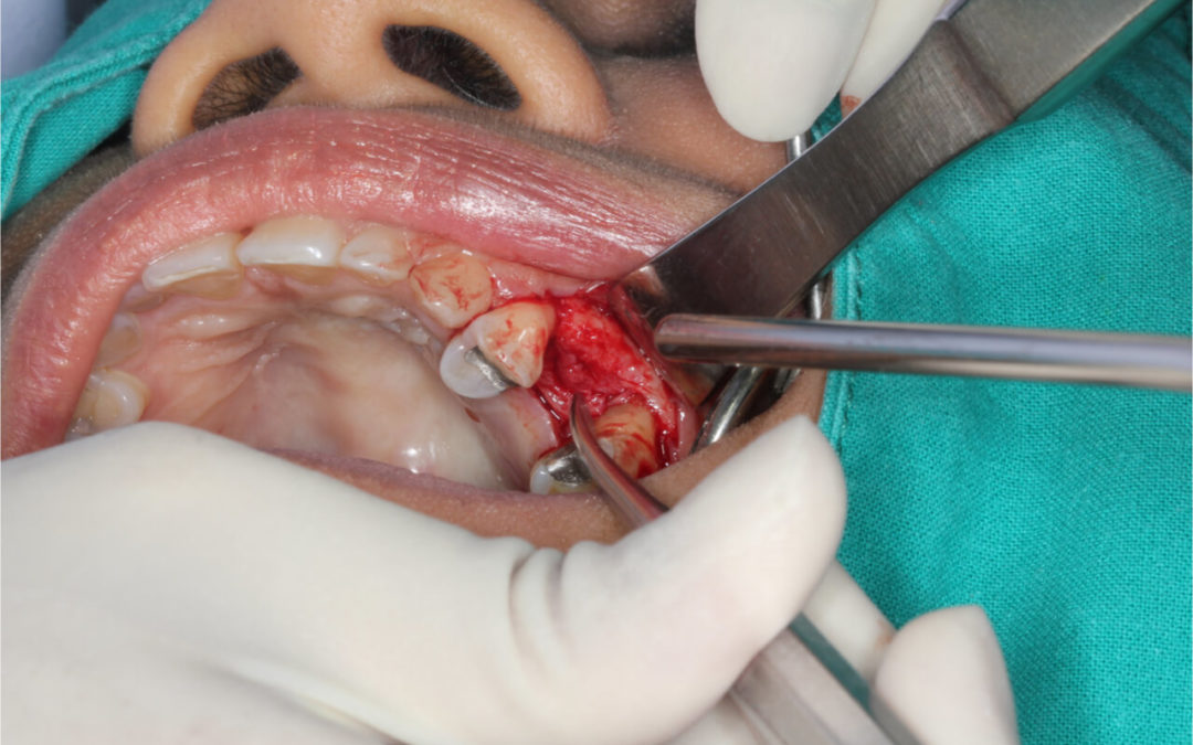 Pinhole gum surgical complications