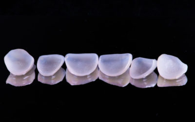 Veneers cost and impact