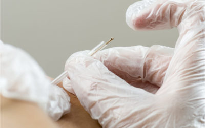 Dry Needling Effectiveness for Dental Pain