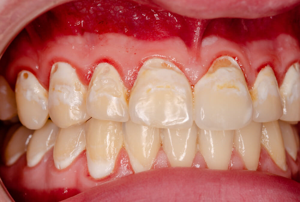 Health risks of necrotizing gingivitis