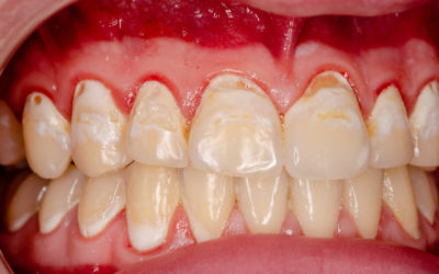 Health risks of necrotizing gingivitis
