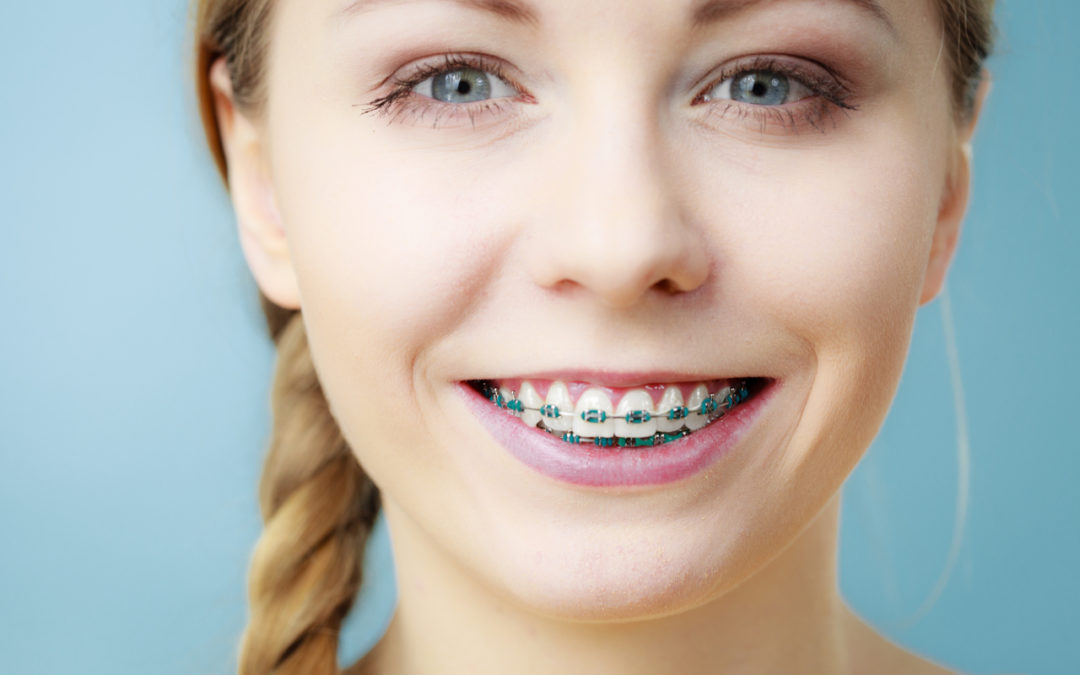 Dental braces