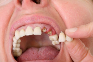 tooth bridge pain