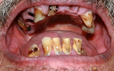 The Facts Behind Rotten Teeth Bad Breath