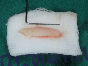 Gum recession treatment cost and preparation