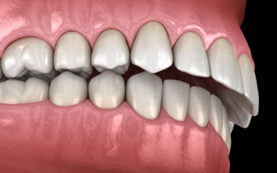 What is an overbite and its treatment