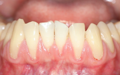 Gum recession treatment cost and preparation