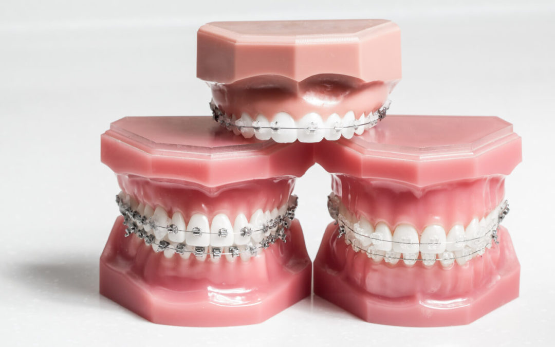 Which is Better: Clear Braces vs Metal