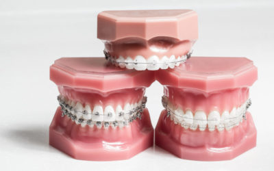 Which is Better: Clear Braces vs Metal