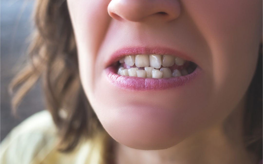 Causes of Crooked Teeth and How to Treat It