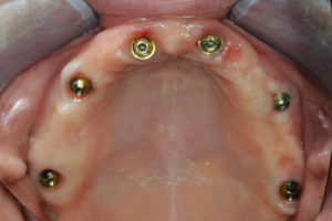 Ideal Implant Dental Procedures And Advance Technology