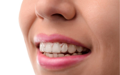 Invisalign (Overbite, Underbite And Malocclusion Correction)