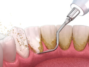 surgical treatment dentist immediately